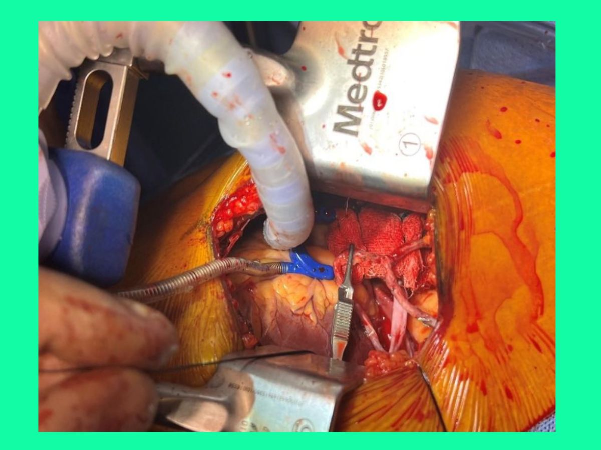 phau-thuat-bac-cau-chu-vanh-2