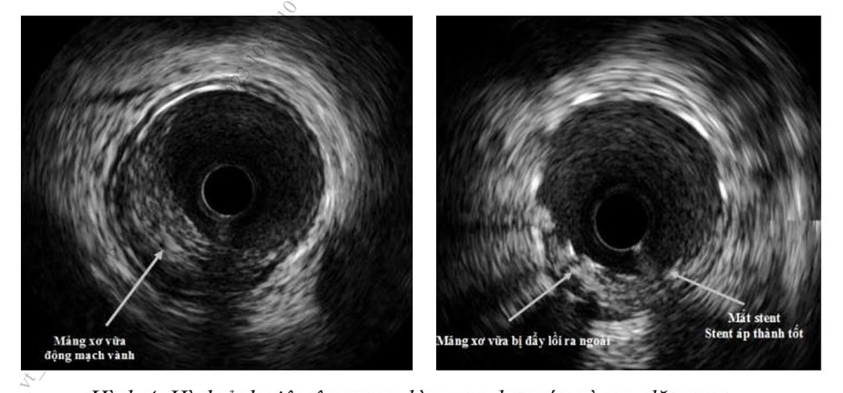 Hình 4. Hình ảnh siêu âm trong lòng mạch trước và sau đặt stent(Nguồn: Viện Tim mạch Việt Nam)