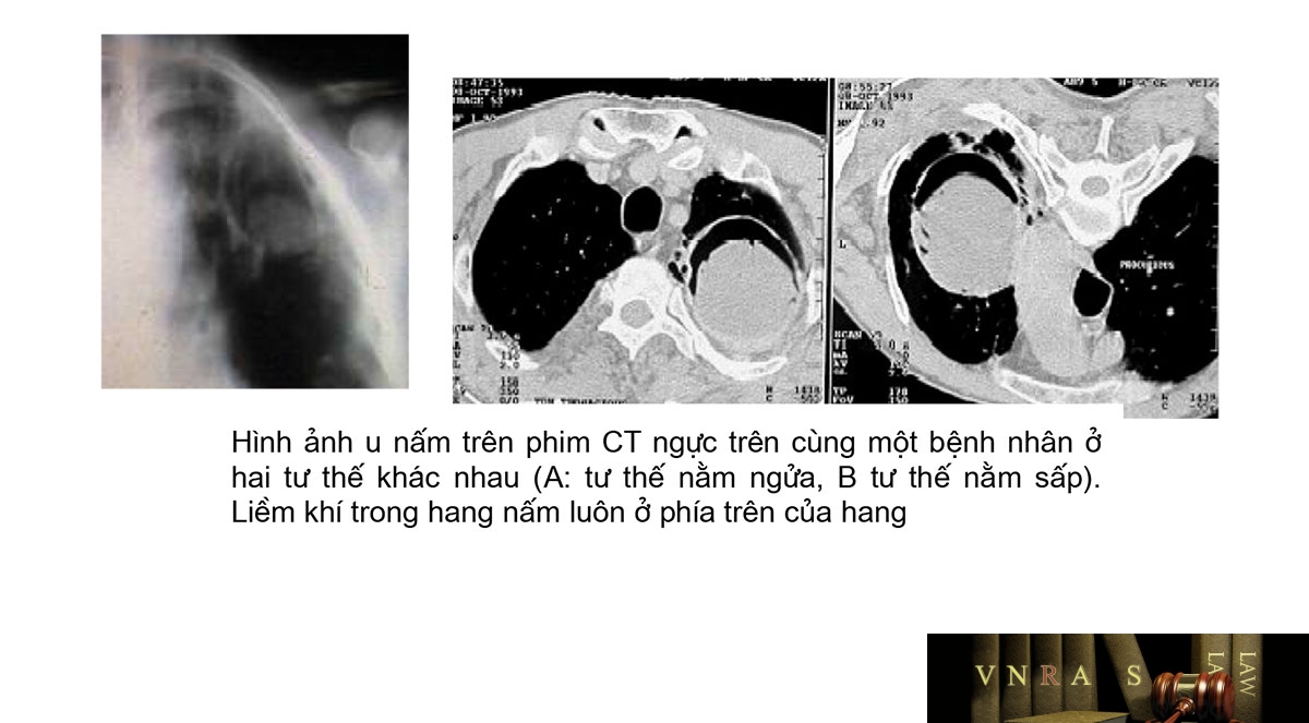 Hình ảnh u nấm trên phim CT ngực trên cùng một bệnh nhân ở hai tư thế khác nhau (A: tư thế nằm ngửa, B tư thế nằm sấp). Liềm khí trong hang nấm luôn ở phía trên của hang