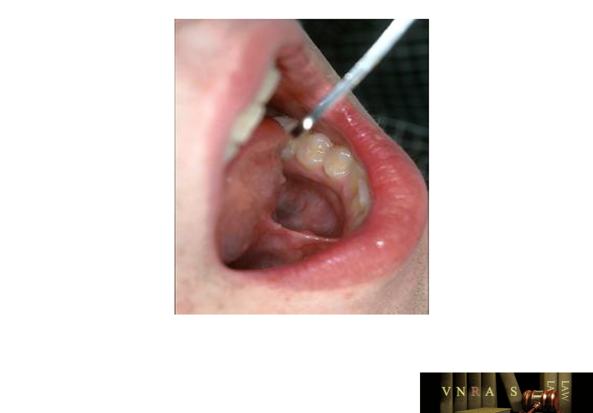 Hình 4. Đường đưa thuốc trong điều trị MDĐH dưới lưỡi