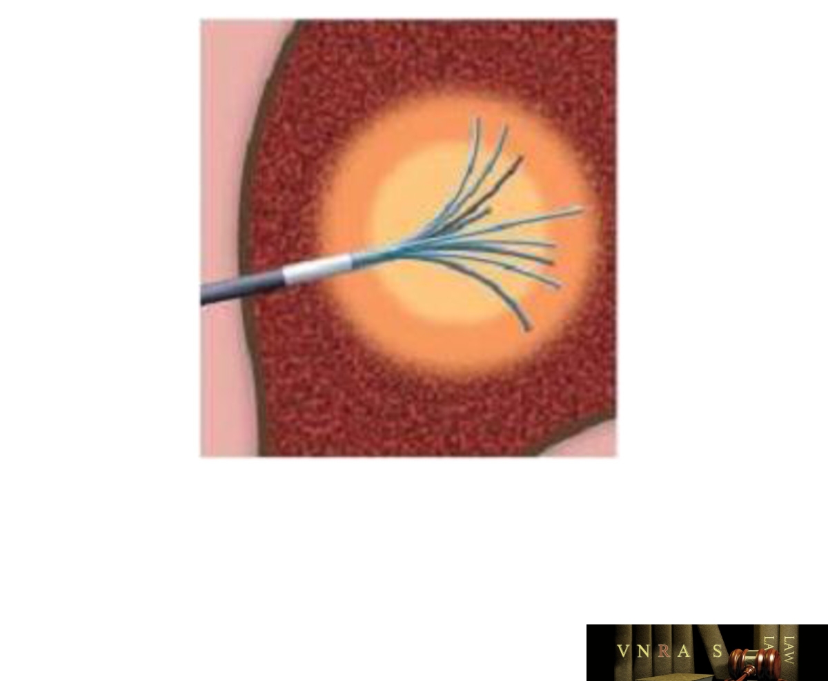 Hình 4.2. Hình ảnh minh họa hoạt động sinh nhiệt của kim đốt trong khối u