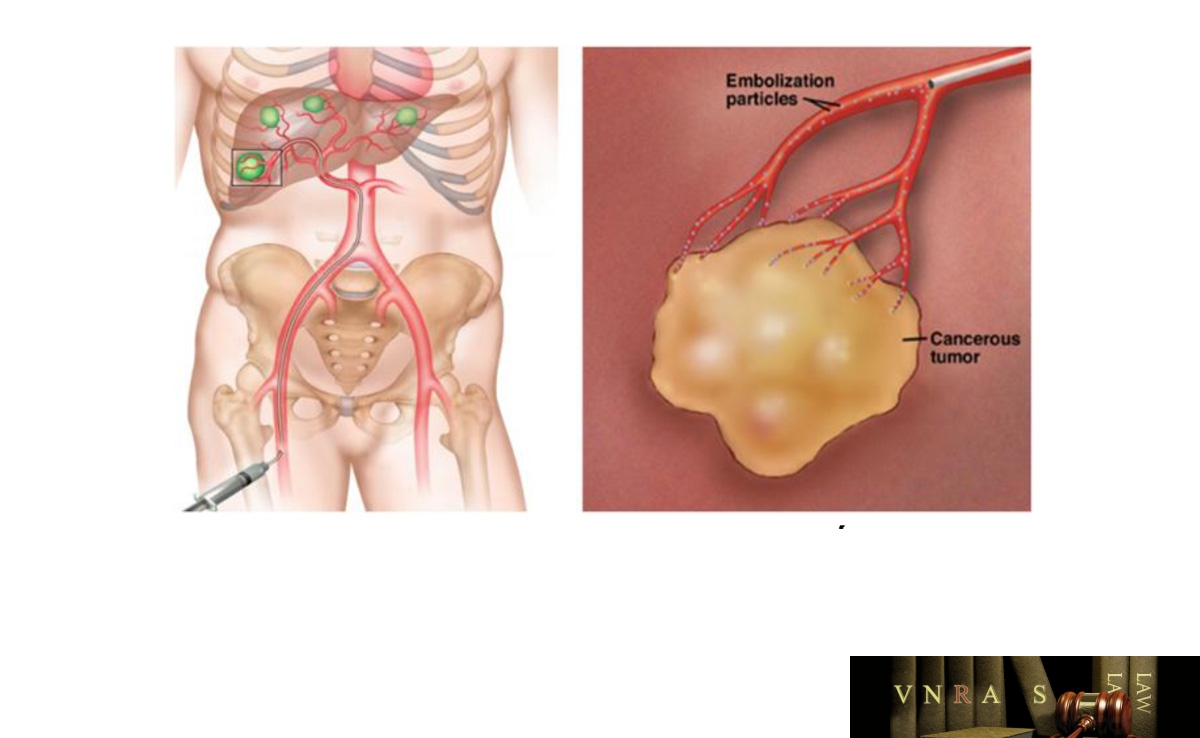 Hình 4.3. Hình ảnh nút mạch khối u gan