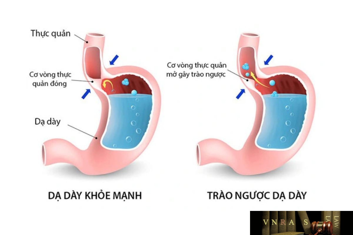 Esomeprazole